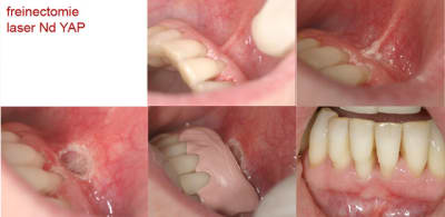 Freinectomie laser recap zhzjnv - Eugenol