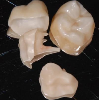 Fz 16 47 inlays core tkswko - Eugenol