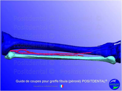 Guide de coupes pour greffe fibula  p ron   positdental 006 izss7x - Eugenol