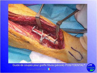 Guide de coupes pour greffe fibula  p ron   positdental 015 oghyju - Eugenol