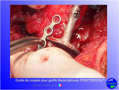 Guide de coupes pour greffe fibula  p ron   positdental 027 q8he4g - Eugenol