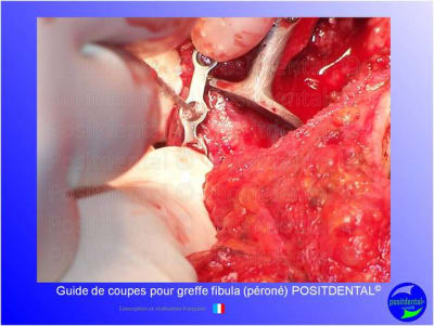 Guide de coupes pour greffe fibula  p ron   positdental 028 suujrw - Eugenol