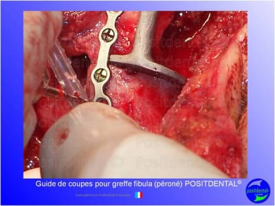 Guide de coupes pour greffe fibula  p ron   positdental 029 hhfpqr - Eugenol