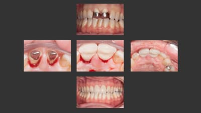 Ic   zircone phhxfb - Eugenol