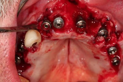 Img implants nekqvy - Eugenol