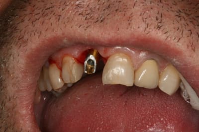 Implant dent 11 009 ryfyox - Eugenol