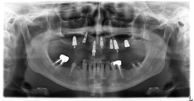 Implantmaroc zobbvd - Eugenol