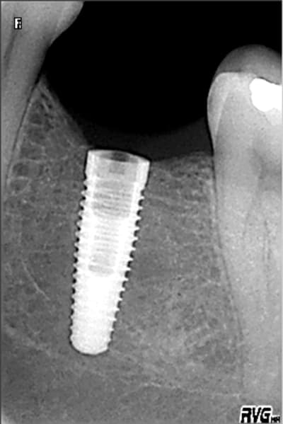 Implant 13 mm p7veoa - Eugenol