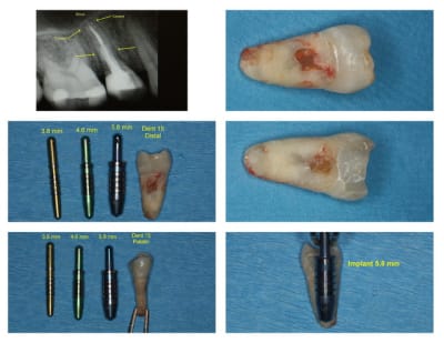 Implant 15 wxg4o7 - Eugenol