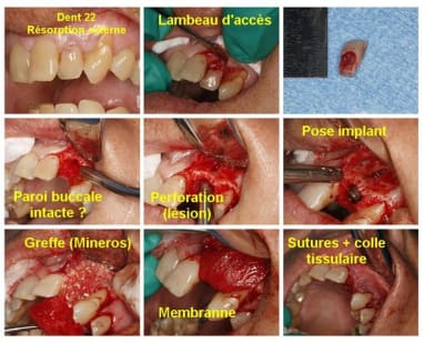 Implant 22 exo pose greffe notes   large  n7nphx - Eugenol