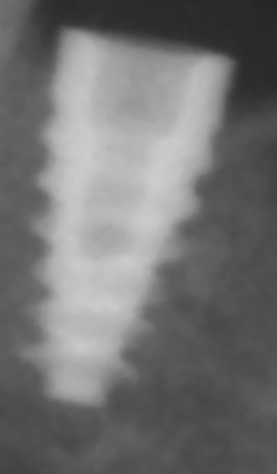 Implant pano   copie v7uja2 - Eugenol