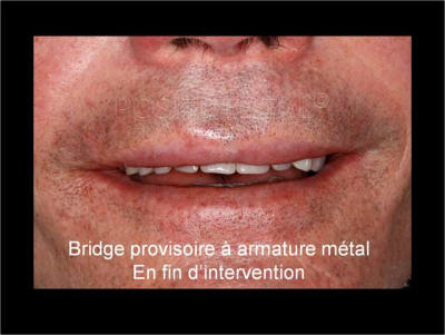Implant tbr z1 et mci 004 uwqjrx - Eugenol