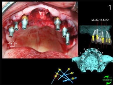 Implant angul  positdental 3 fwv8xx - Eugenol