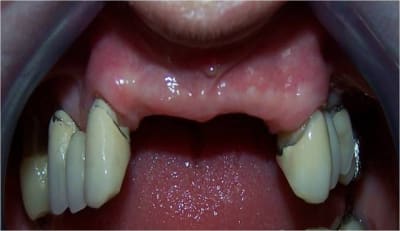 Implant et gestion des tissus conjonctif 01 rf2ueg - Eugenol