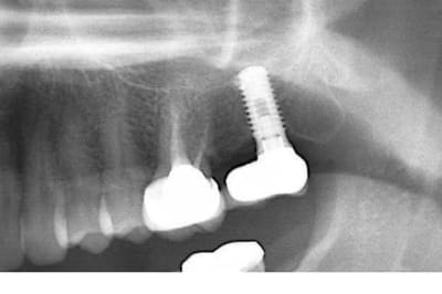Implant fdvuhm - Eugenol