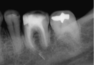Implant vjqkka - Eugenol