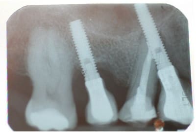 Implantes m83s6f - Eugenol