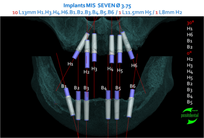 Implants mis seven multi unit hexagone interne mdi22y - Eugenol
