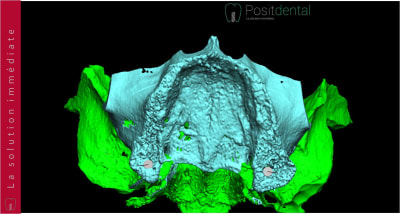 Implants ptérygoïdien 010 dazhli - Eugenol