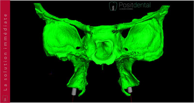 Implants ptérygoïdien 013 yontqp - Eugenol