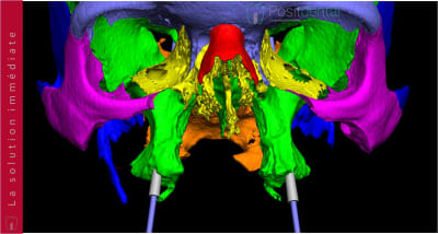 Implants ptérygoïdien 028 cgybrl - Eugenol