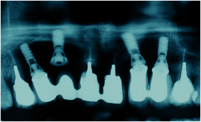 Implants q5f02j - Eugenol