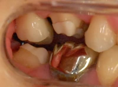 Inlays cores zircone en place djkxxt - Eugenol