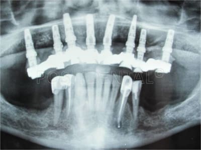 Lambeau   minima avec un guide chirurgical   appuis osseux 06 dbiig0 - Eugenol