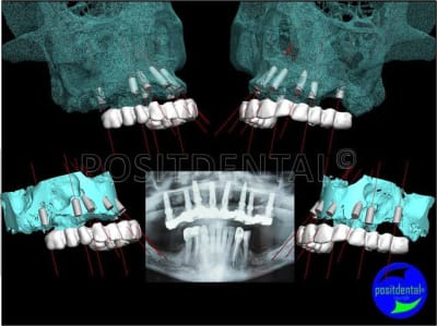 Lambeau   minima avec un guide chirurgical   appuis osseux 07 ayill1 - Eugenol