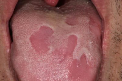 Langue d papill e hbf8db - Eugenol