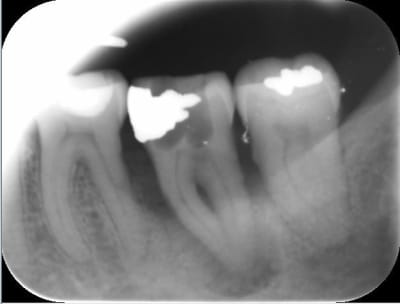 Lesion endo paro bdwn58 - Eugenol