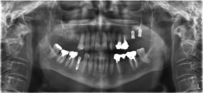 Matri bone rexmse - Eugenol
