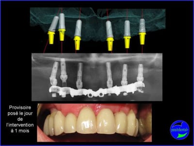 Mci  positdental m4zquk - Eugenol