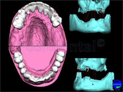 Mcipe bi maxillaire du 13 f vier 2012 003 gakn21 - Eugenol