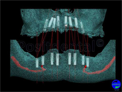 Mcipe bi maxillaire du 13 f vier 2012 007 puwpqf - Eugenol