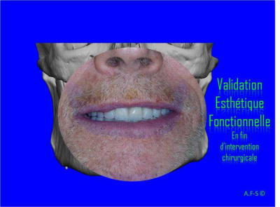 Mci bi maxillaire 3 obv29q - Eugenol