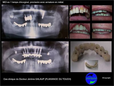 Mci mise en charge imm diate 001 arcvlz - Eugenol