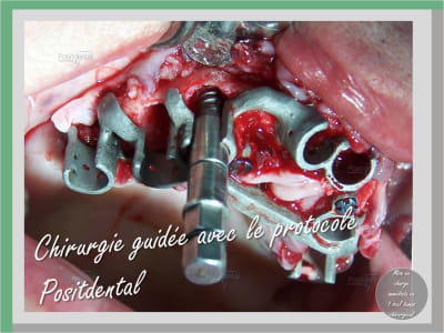 Mise en charge en 1 seul temps chirurgical 002 pkherh - Eugenol