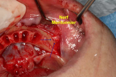 Mentonnier  2 xa5jdf - Eugenol