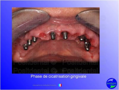 Mise en chage imm diate 116 duimce - Eugenol