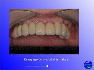 Mise en chage imm diate 118 fbti0h - Eugenol