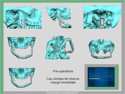 Mise en charge immédiate   immediate loading  hardware manufacturer - Eugenol