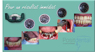 Mise en charge immédiate   protocole positdental 002 mkmbzx - Eugenol