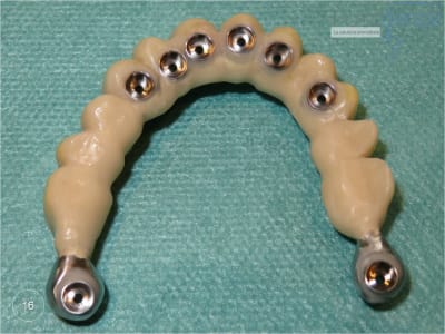 Mise en charge immédiate   chirurgie guidée 16 ghdxrh - Eugenol