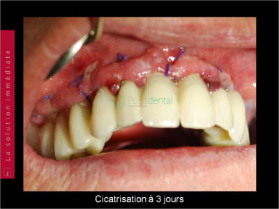 Mise en charge immédiate   chirurgie guidée guide chirurgical 003 gq4iov - Eugenol