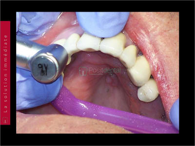 Mise en charge immédiate   chirurgie guidée guide chirurgical 009 dyyq0p - Eugenol