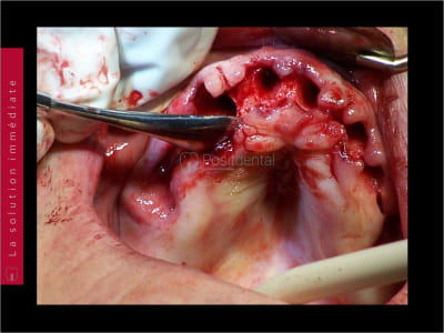 Mise en charge immédiate   chirurgie guidée guide chirurgical 015 dymhex - Eugenol