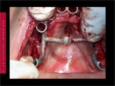 Mise en charge immédiate   chirurgie guidée guide chirurgical 025 zj32wp - Eugenol