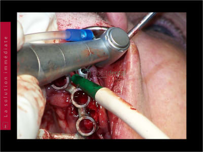 Mise en charge immédiate   chirurgie guidée guide chirurgical 031 zfypnb - Eugenol