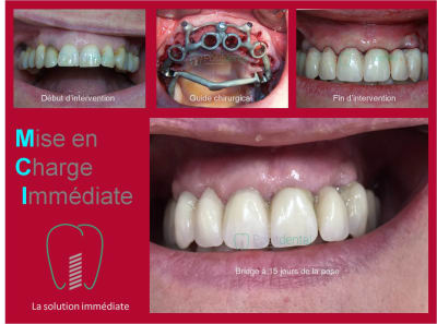 Mise en charge immédiate 001 m0tyuq - Eugenol